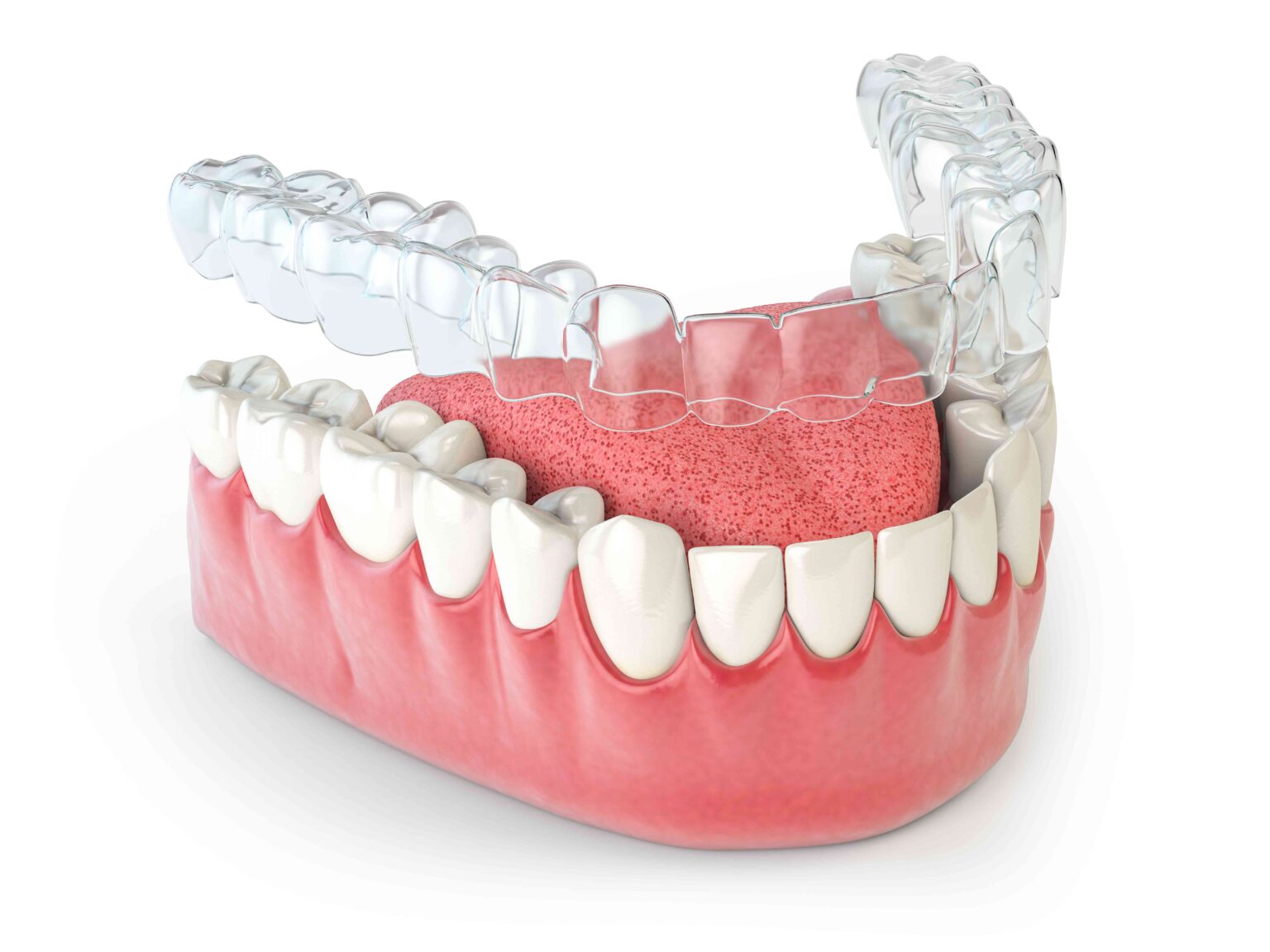 Invisalign invisible retainer or braces with lawer jaw islated on white.