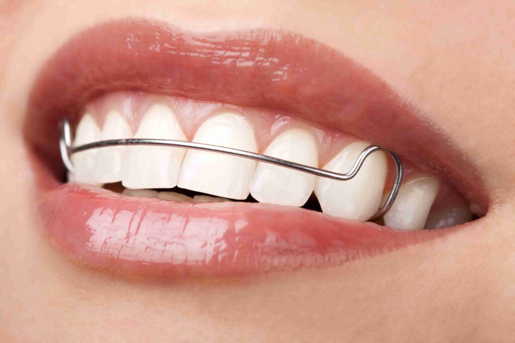 woman-beautiful-teeth-with-retainer-orthodontic-co-2021-08-31-13-25-11-utc (1)