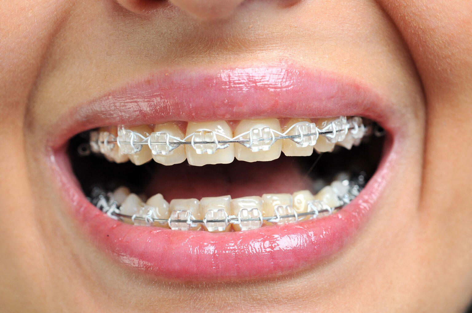 Close-up of ceramic and metallic braces on teeth. Orthodontic Treatment. Dental Care
