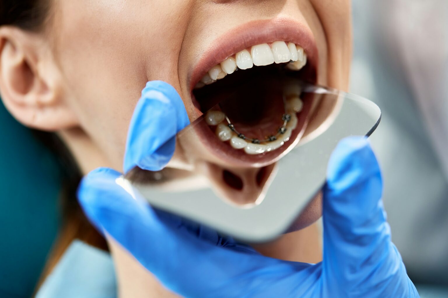 Close-up of orthodontist checking lingual braces of female patient with a mirror.