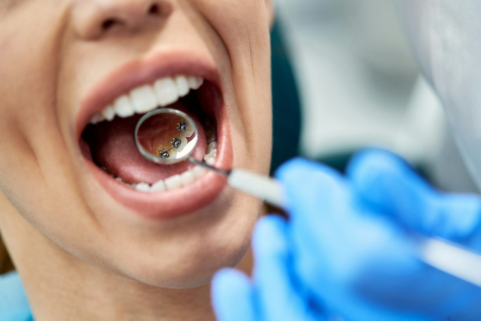 Close-up of woman during lingual braces check-up at dental clinic.