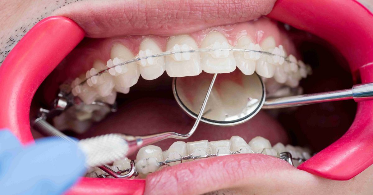macro-shot-of-teeth-with-braces-and-dental-retract-2022-05-11-00-34-38-utc (1)